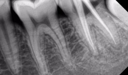 根管治疗视频,从视频学习根管治疗技巧与流程